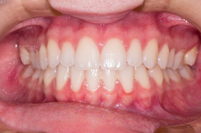 rovné zuby